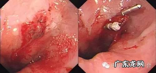 喝酒后吐血可能是什么原因?