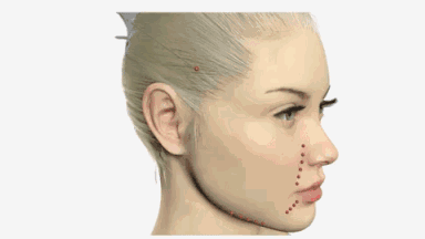 蛋白埋线原理,蛋白埋线术前术后注意事项