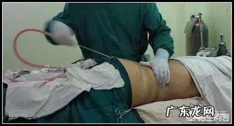 吸脂减肥适合哪些人?