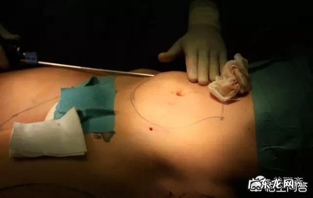 吸脂减肥适合哪些人?