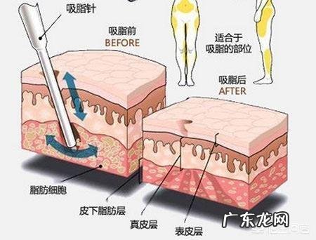 吸脂减肥适合哪些人?