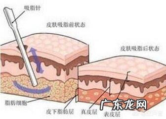 吸脂减肥适合哪些人?