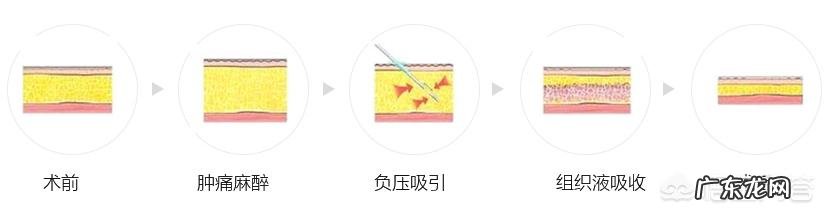 吸脂减肥适合哪些人?