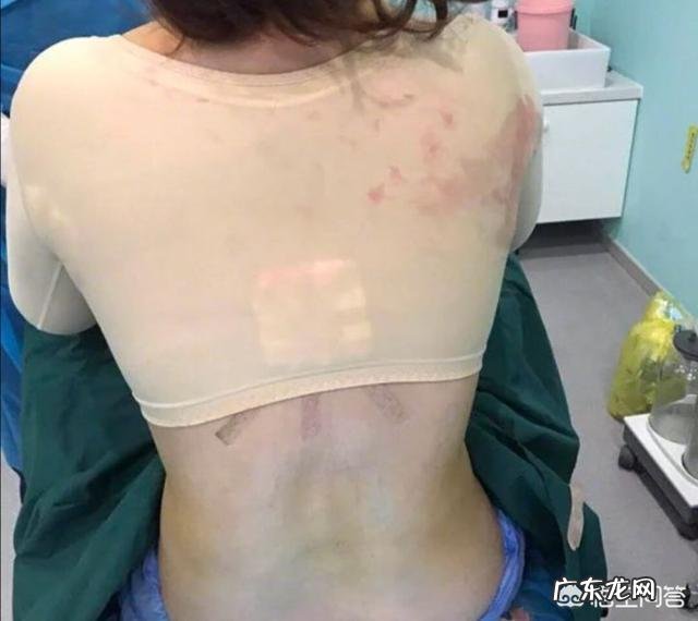 吸脂减肥适合哪些人?