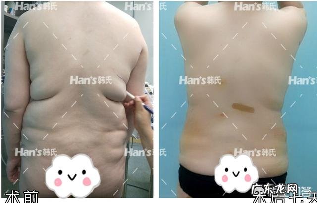 吸脂减肥适合哪些人?