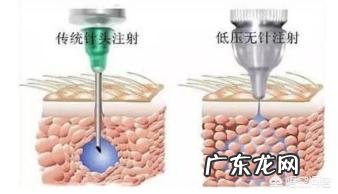 无针水光好还是有针水光好?