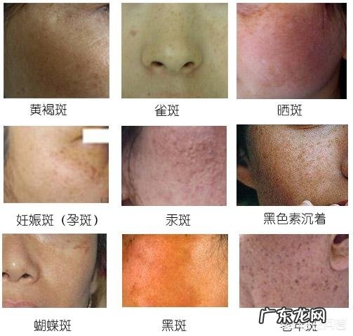 红霉素、阿莫西林和白醋一起用,可以祛斑美白吗?