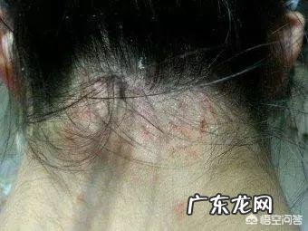 如何去头屑?头皮屑非常多,用过多种洗发露都没用,有啥好方法?