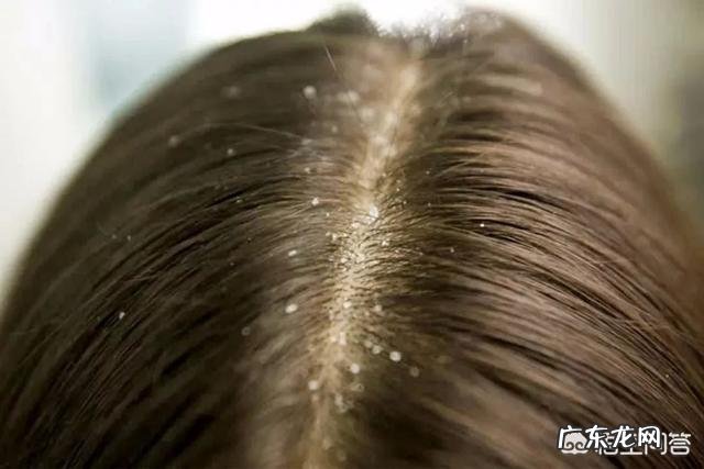 如何去头屑?头皮屑非常多,用过多种洗发露都没用,有啥好方法?