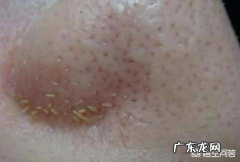 夏天鼻子出油多，而且经常长粉刺，有什么办法能控油去粉刺吗？