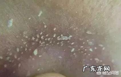 夏天鼻子出油多,而且经常长粉刺,有什么办法能控油去粉刺吗?