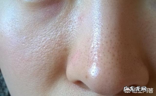 夏天鼻子出油多,而且经常长粉刺,有什么办法能控油去粉刺吗?