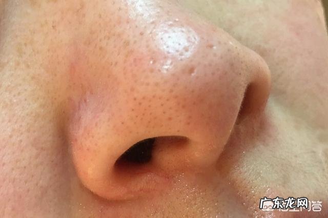 夏天鼻子出油多,而且经常长粉刺,有什么办法能控油去粉刺吗?