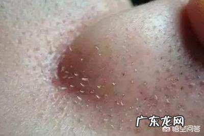 夏天鼻子出油多,而且经常长粉刺,有什么办法能控油去粉刺吗?