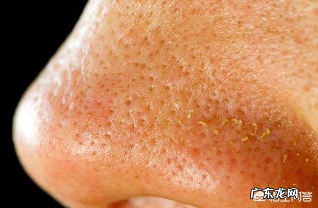 夏天鼻子出油多,而且经常长粉刺,有什么办法能控油去粉刺吗?