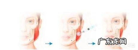 瘦脸针安全吗?注射瘦脸针后要注意什么?