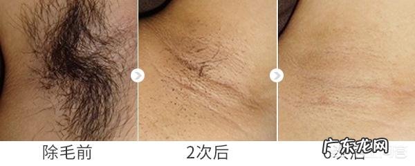 怎样去除腿毛不再长出?