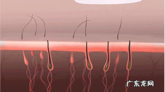 怎样去除腿毛不再长出?