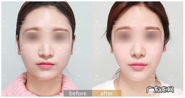 脸部抽脂怎么样?