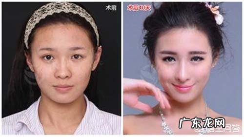 假体硅胶隆鼻用不用耳软骨垫鼻尖有什么区别？有垫的必要性吗？