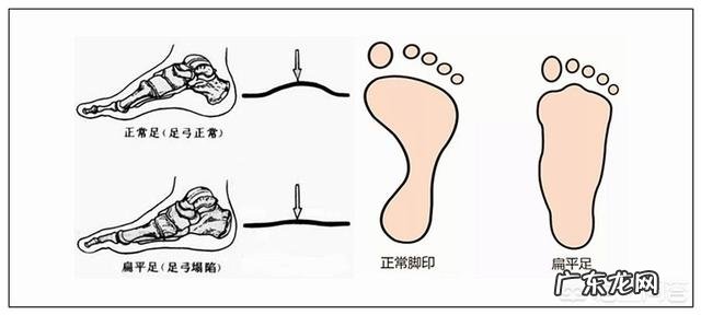 扁平足可以矫正吗?有哪些矫正方法?