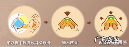 硅胶假体隆鼻好吗?术后注意事项?需要我们如何进行护理?