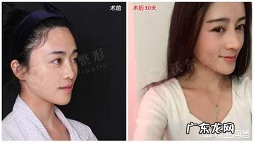 硅胶假体隆鼻好吗?术后注意事项?需要我们如何进行护理?