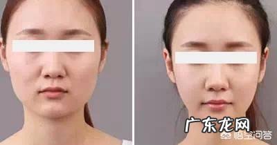 硅胶假体隆鼻好吗？术后注意事项？需要我们如何进行护理？