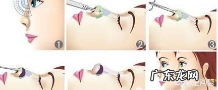 硅胶假体隆鼻好吗？术后注意事项？需要我们如何进行护理？