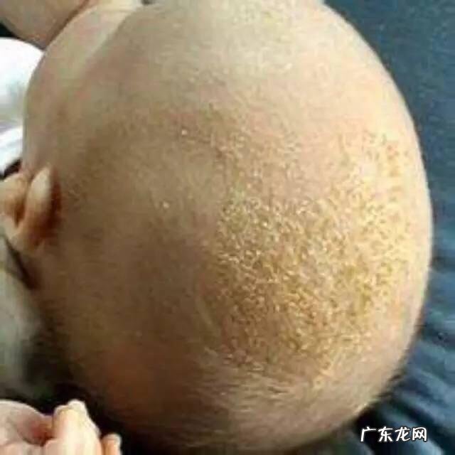 宝宝头上的乳痂可以洗吗?