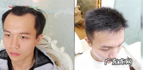 发际线天生靠后怎么修饰？