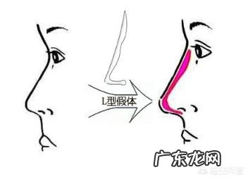 假体隆鼻是什么原理,对鼻子有伤害吗?