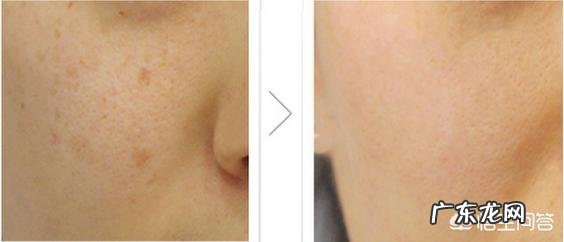 光子嫩肤好,还是水光针好?两者能同时做吗?