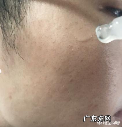 烟酰胺能祛痘印吗?