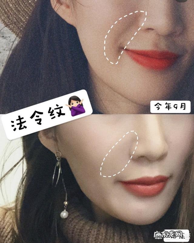 法令纹怎么除比较快？