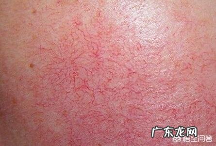 用什么可以去掉红血丝?