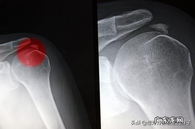 手臂酸疼,胳膊都抬不起来,手臂及肩膀疼得钻心刮骨,是什么原因?