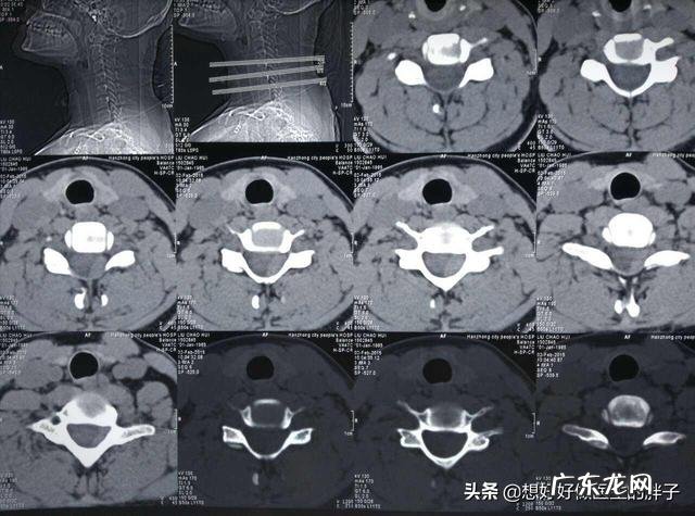 手臂酸疼,胳膊都抬不起来,手臂及肩膀疼得钻心刮骨,是什么原因?