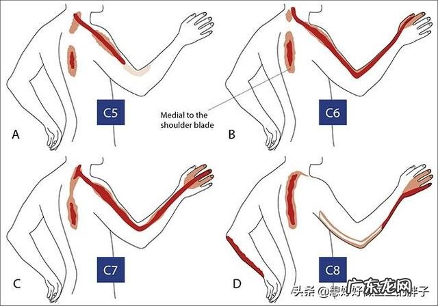 手臂酸疼,胳膊都抬不起来,手臂及肩膀疼得钻心刮骨,是什么原因?