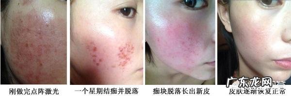 脸上的红血丝可以去掉吗？