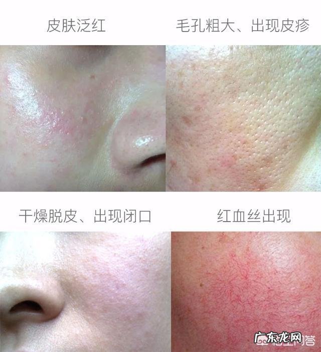 脸上的红血丝可以去掉吗?