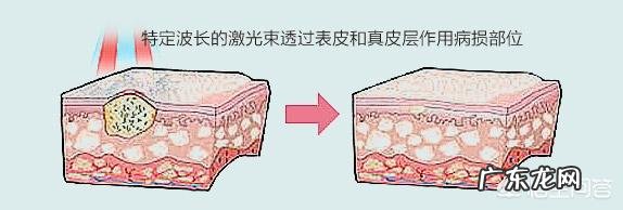 脸上的红血丝可以去掉吗?