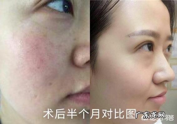 脸上的红血丝可以去掉吗?