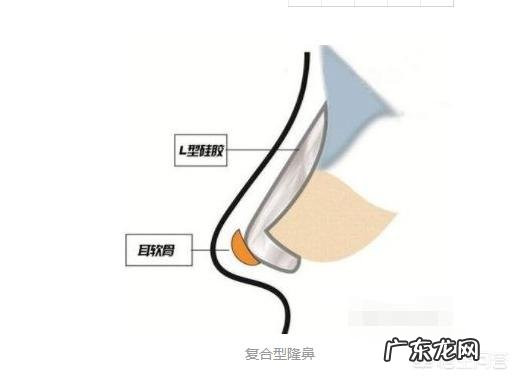 耳软骨隆鼻是永久的吗？会不会吸收后变成原来的样子？定型恢复后还会不会吸收？