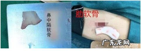 耳软骨隆鼻是永久的吗？会不会吸收后变成原来的样子？定型恢复后还会不会吸收？