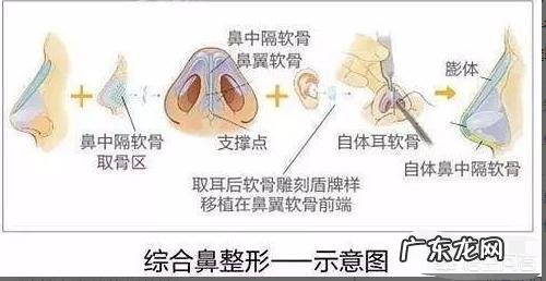 耳软骨隆鼻是永久的吗？会不会吸收后变成原来的样子？定型恢复后还会不会吸收？
