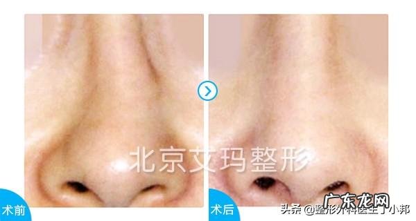 耳软骨隆鼻是永久的吗？会不会吸收后变成原来的样子？定型恢复后还会不会吸收？