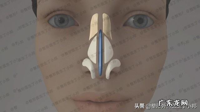 耳软骨隆鼻是永久的吗？会不会吸收后变成原来的样子？定型恢复后还会不会吸收？