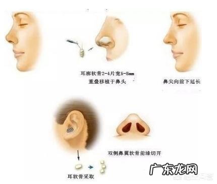 自体隆鼻好还是假体好，有哪些区别？