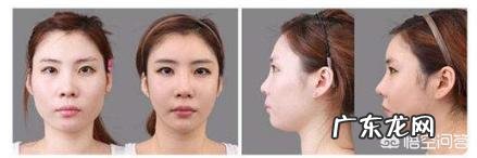 自体隆鼻好还是假体好,有哪些区别?